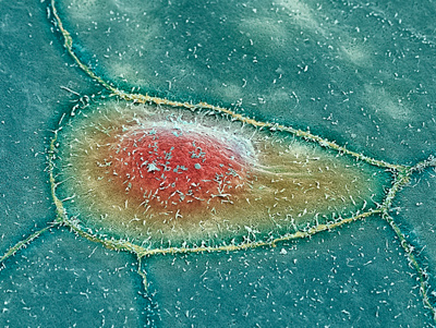 Rectal cancer cells. Coloured scanning electron micrograph (SEM) of rectal adenocarcinoma cells (blue). The cells have grown very close together, forming a sheet. The nucleus (red) of central cell is seen. Adenocarcinomas are cancers that arise from glandular tissue in the lining of an organ. The small projections, or microvilli, on the cells' surface are typical of cancer cells. Colorectal cancer is one of the most common cancers in the western world. Risk factors include a diet high in animal fat and low in fibre and a sedentary lifestyle.