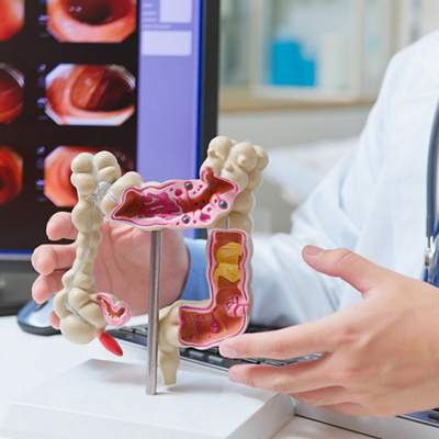 Colonoscopy vs. Stool Tests