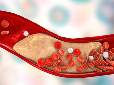 Coronary-artery-disease