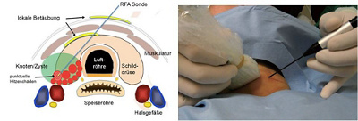 Darstellung Ablation