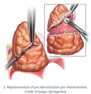 Decortication_thoracotomie