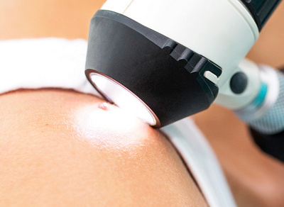 Untersuchung Hautkrebs