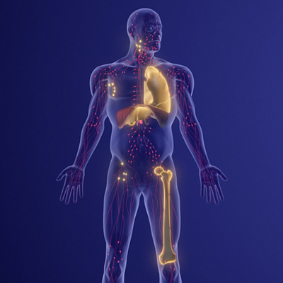 Early Symptoms of Sarcoma