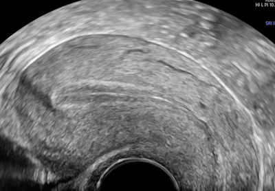 Echographie_Gynecologique_2