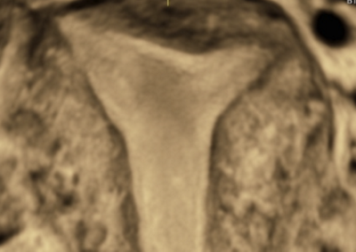 Echographie_pelvienne