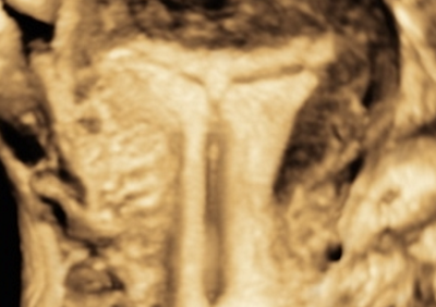 Echographie_pelvienne_1