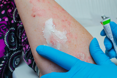Eczema- 1152 x 768 - 1