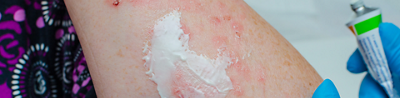 Will my eczema ever go away?
