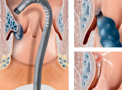 Endoskopischen Gummiband-Ligatur («Speedband»)