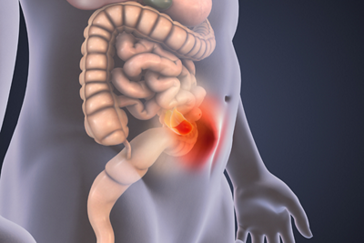 FOHC Hernia- 1152 x 768 - 1