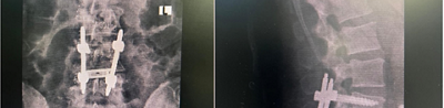 A first for Gauteng: Mediclinic Vereeniging orthopaedic surgeon performs complex endoscopic spinal surgery