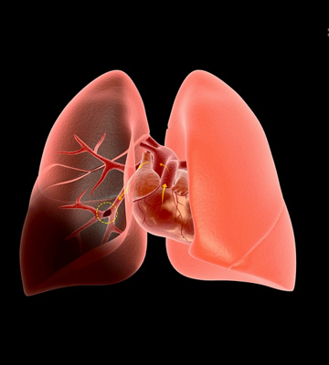 Embolie pulmonaire