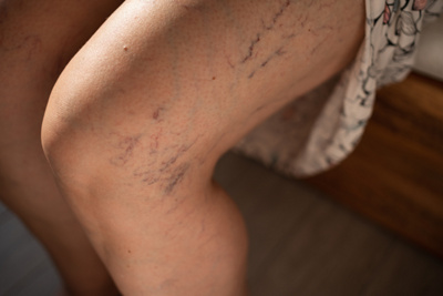 Varicose veins on the thigh
