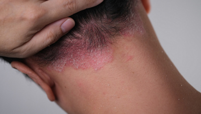 Plaque Psoriasis