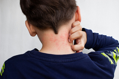 5 Things to know about your child's skin rash