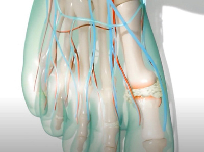 Visualisation of gout on the big toe