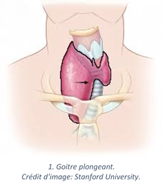 Goitre_thyroidien