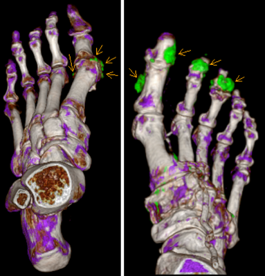 Darstellung der Harnsäurekristalle in der Dual- Energy-CT