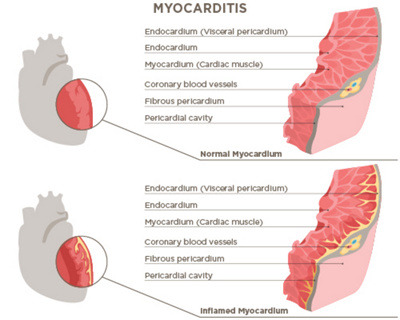 Myocarditis