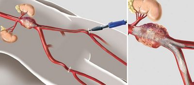 Hirslanden-Die-Behandlung-des-Bauchaortenaneurysmas-ein-kurzer-Überblick-1