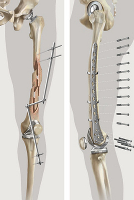 Hirslanden-Frische-Knochenbrüche-bei-Gelenkprothese-chirurgisch-anspruchsvoll-und-immer-häufiger-1
