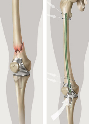 Hirslanden-Frische-Knochenbrüche-bei-Gelenkprothese-chirurgisch-anspruchsvoll-und-immer-häufiger-2