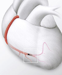 Hirslanden-Herzinfarkt-ein-Wettlauf-mit-der-Zeit-1