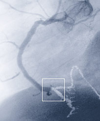 Hirslanden-Herzinfarkt-ein-Wettlauf-mit-der-Zeit-2