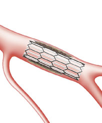 Hirslanden-Herzinfarkt-ein-Wettlauf-mit-der-Zeit-4