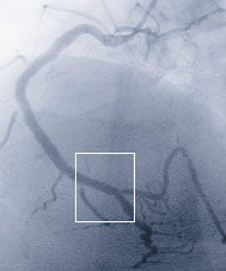 Hirslanden-Herzinfarkt-ein-Wettlauf-mit-der-Zeit-5