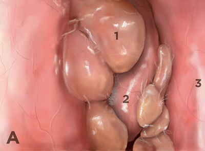 Hirslanden-Konservative-und-chirurgische-Behandlung-der-oberen-Atemwege-1