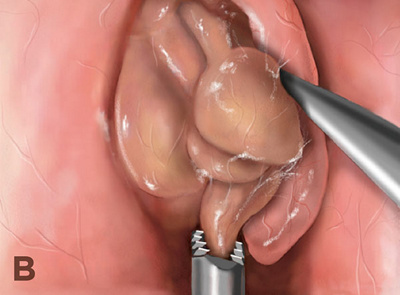 Hirslanden-Konservative-und-chirurgische-Behandlung-der-oberen-Atemwege-2