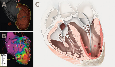 Hirslanden-Neue-Methode-zur-Behandlung-von-Rhythmusstörungen-aus-der-Herzkammer-1
