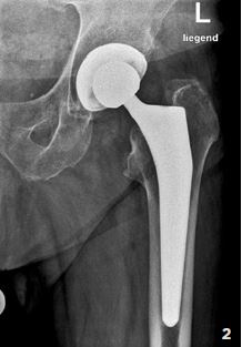 Hüftgelenk 2