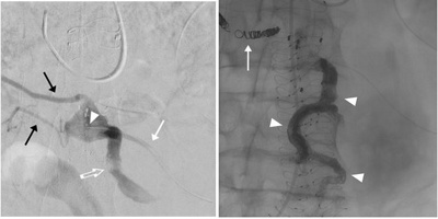 Katheter-Embolisation