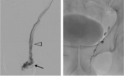 Katheterembolisation