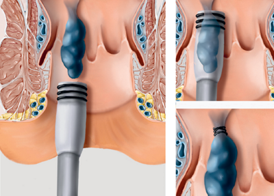 Konventionelle Gummiband-Ligatur mithilfe eines Proktoskops