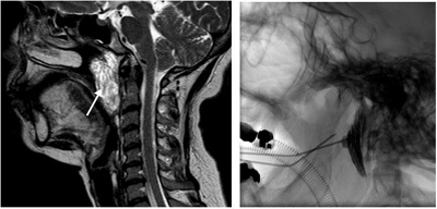 Kopf Hals Mikrotherapie