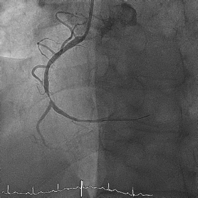 Koronare Herzkrankheit