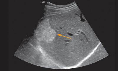 Der Leber-Ultraschall zeigt ein gutartiges Hämangiom (Blutschwamm).