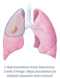 Lobectomie