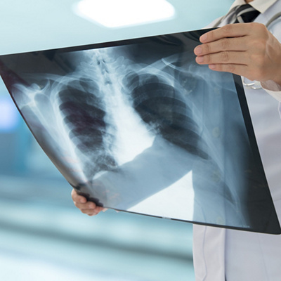 Lung Cancer vs. Other Respiratory Diseases