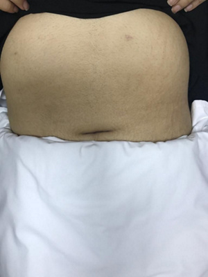 MAIN Bariatric surgeries 2