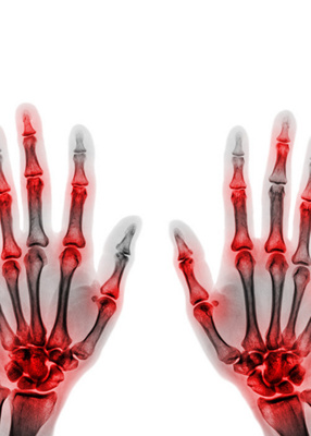 MAIR-Rheumatic-disorder