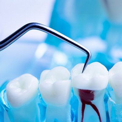 MAIR-Root-Canal-Treatments