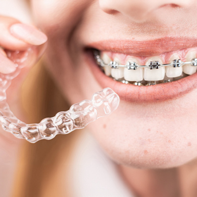 MAIR-Types-of-Dental-Braces
