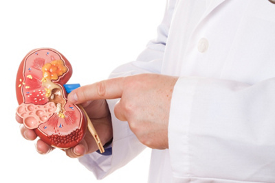 MC Kidney Stones_GettyImages-186873336_resized