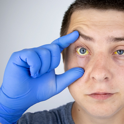 MCIT-Liver-Yellow-Eyes