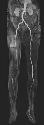 MRA-Gefässverschluss-rechter-OS