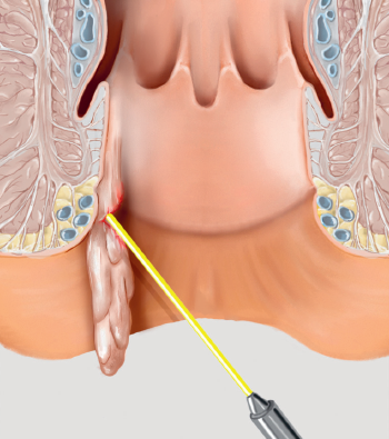 перианальный венозный тромбоз что это